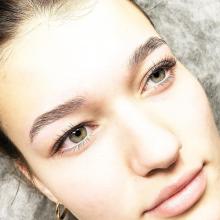 Brow Lifting 