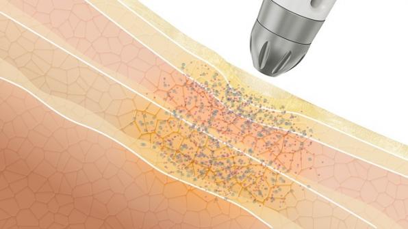 DERMADROP ermöglicht die Behandlung für nahezu jeden Hautzustand – auch bei Problemhaut, Akne, Rosazea und Couperose.