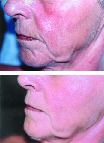 bdr® / Micro Needling vorher-nachher