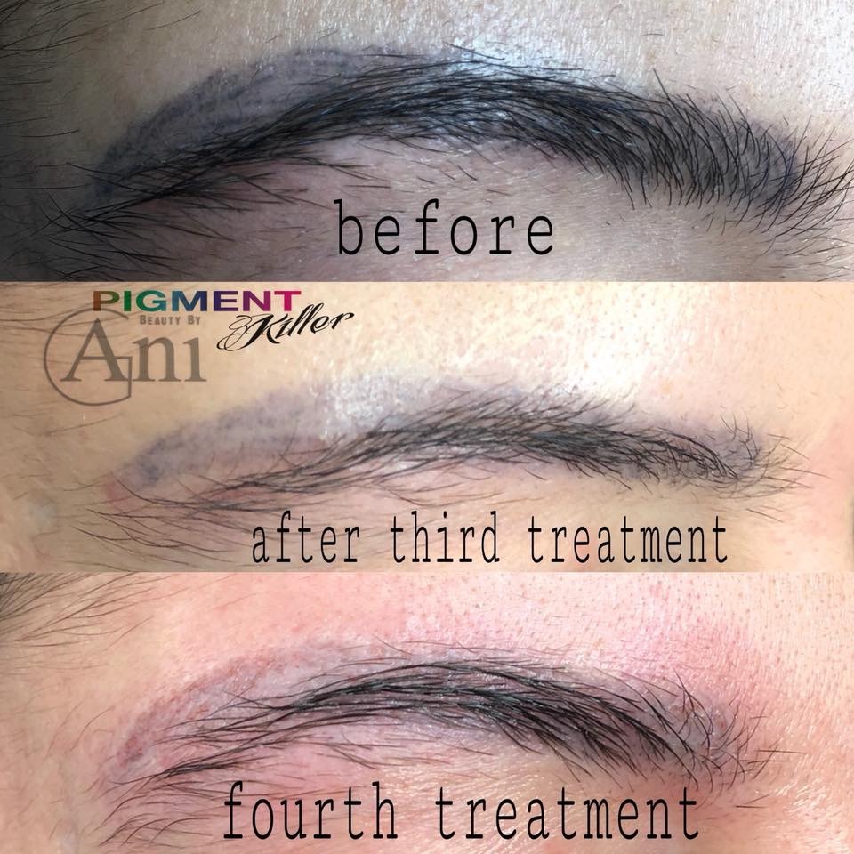 Pigmententfernung mit Pigment Killer