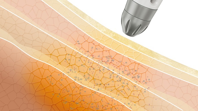 DERMADROP ermöglicht die Behandlung für nahezu jeden Hautzustand – auch bei Problemhaut, Akne, Rosazea und Couperose.